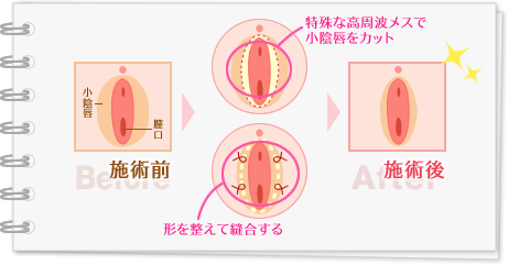 施術前 施術後